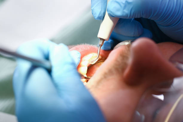 Best Emergency Tooth Extraction in Brooksville, FL