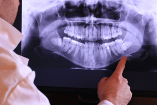 Best Emergency Wisdom Teeth Removal in Brooksville, FL