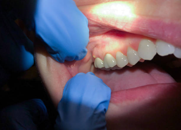 Best Emergency Treatment for Dental Infections or Abscesses in Brooksville, FL