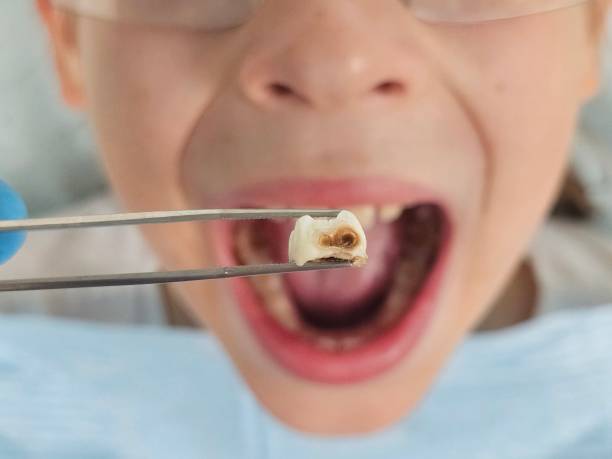 Best Emergency Gum Treatment in Brooksville, FL