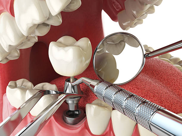 Best Emergency Treatment for Dental Infections or Abscesses in Brooksville, FL